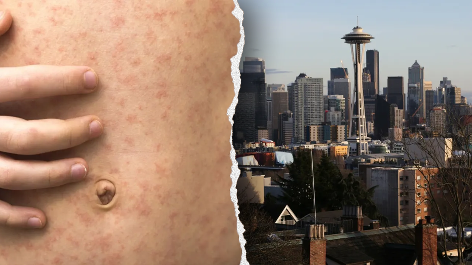 Measles Alert: Canadian Traveler Sparks Outbreak Fears in Seattle Area