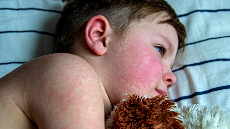 Measles Death Reported in West Texas Amid Outbreak