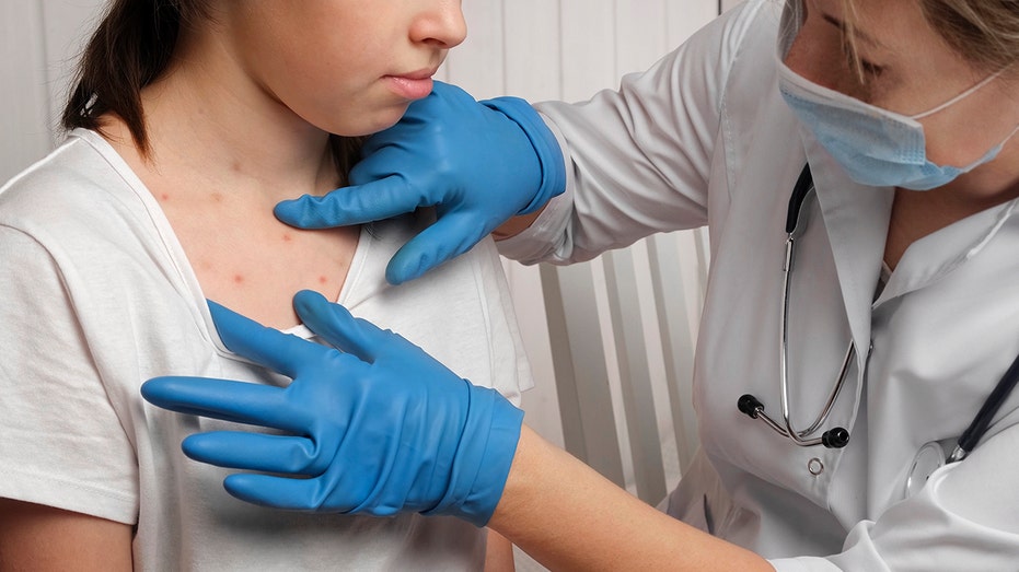 Virginia Reports First Measles Case of Year in Young Child After International Trip