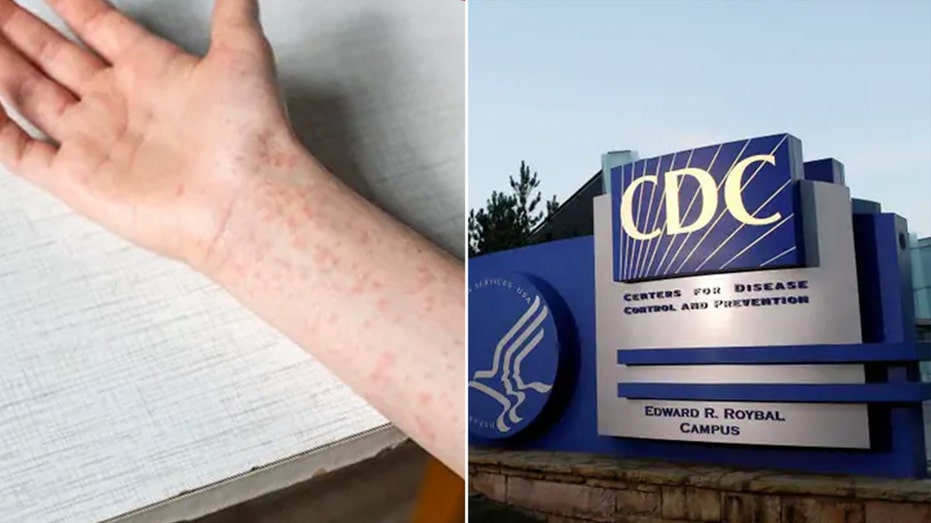 Texas Measles Outbreak Hits 561 Cases as CDC Rolls Out Reinforcements