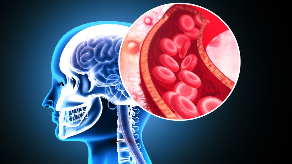 Stanford’s Milli-Spinner Breakthrough Doubles Stroke Treatment Success