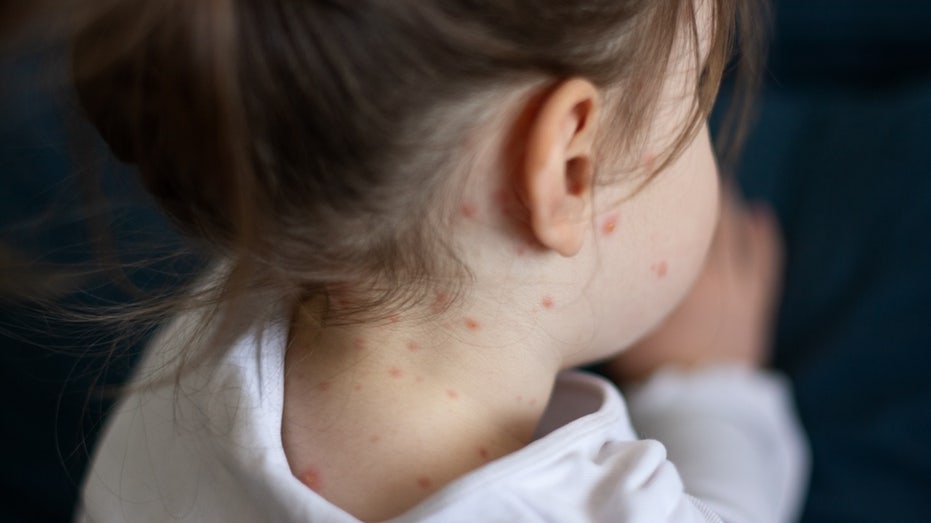 Measles Cases Surge Across Multiple States After Tragic Child Death