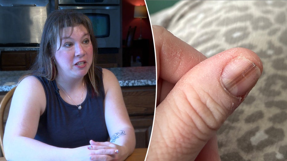 TikTok Video Saves Mom’s Life After Strange Nail Mark Reveals Rare Cancer