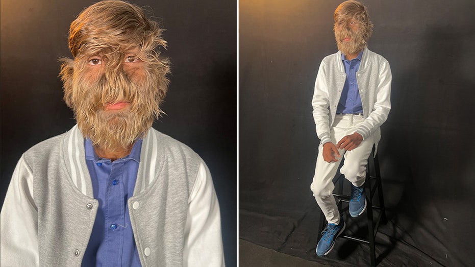 Teen with ‘Werewolf Syndrome’ Breaks World Record for Hairiest Face