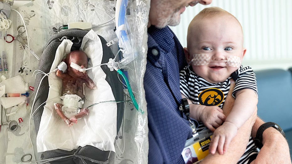 World’s Most Premature Baby Nash Keen Defies Odds to Celebrate First Birthday